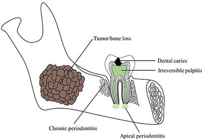 Application of Stem Cells in Oral Disease Therapy: Progresses and Perspectives